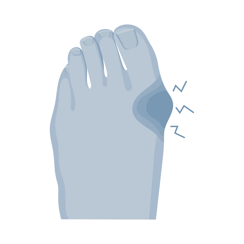 Illustration d'un hallux valgus